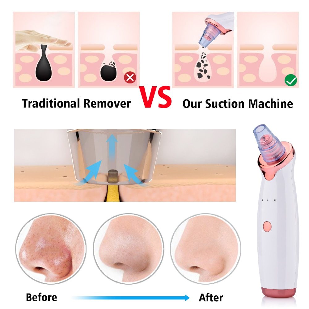Beauty Acne Cleaning Blackhead Suction Instrument