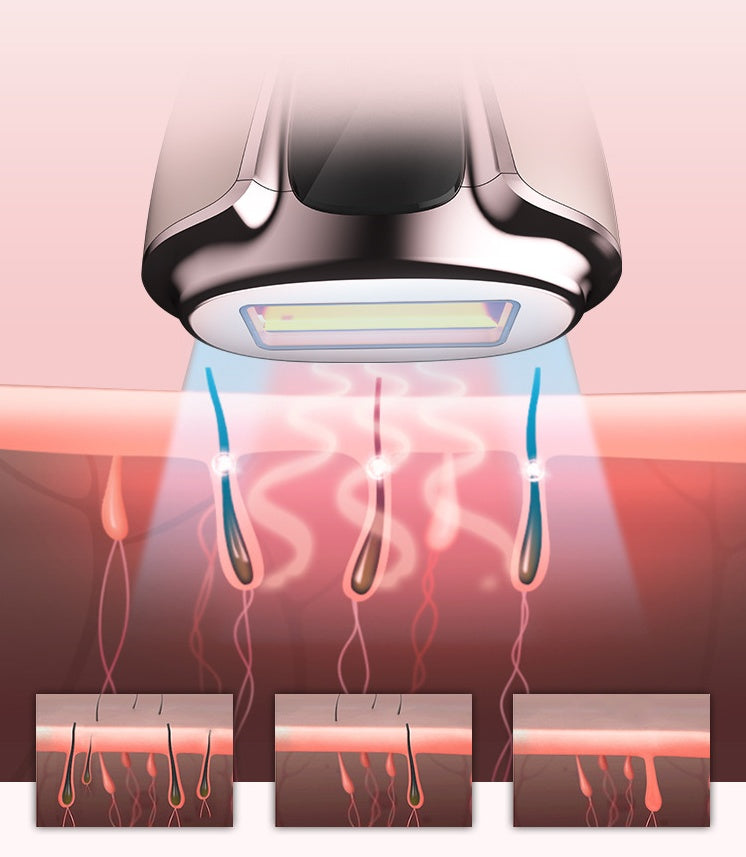 Home laser hair removal device